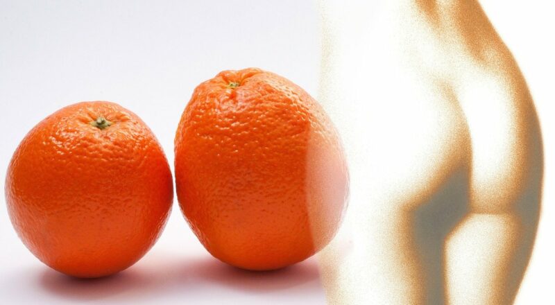 Cellulite